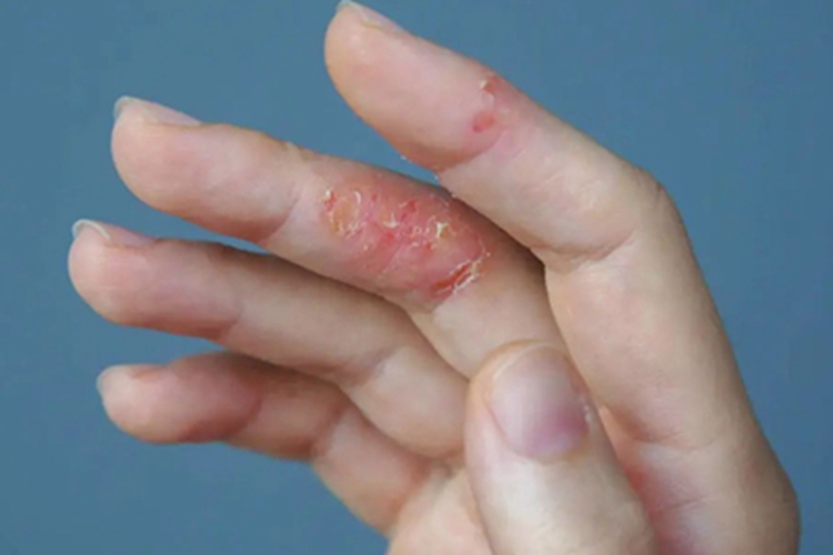 汗疱疹手指脱皮图 汗疱疹手指脱皮图