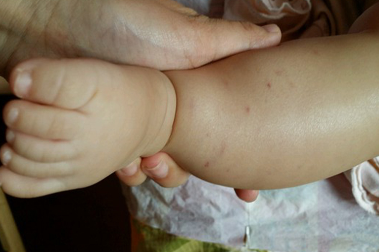 宝宝过敏性紫癜图 宝宝过敏性紫癜图