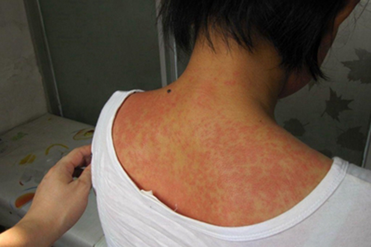 急性接触性皮炎背部红斑图
