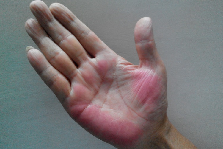 肝硬化手掌发红图 肝硬化手掌发红图