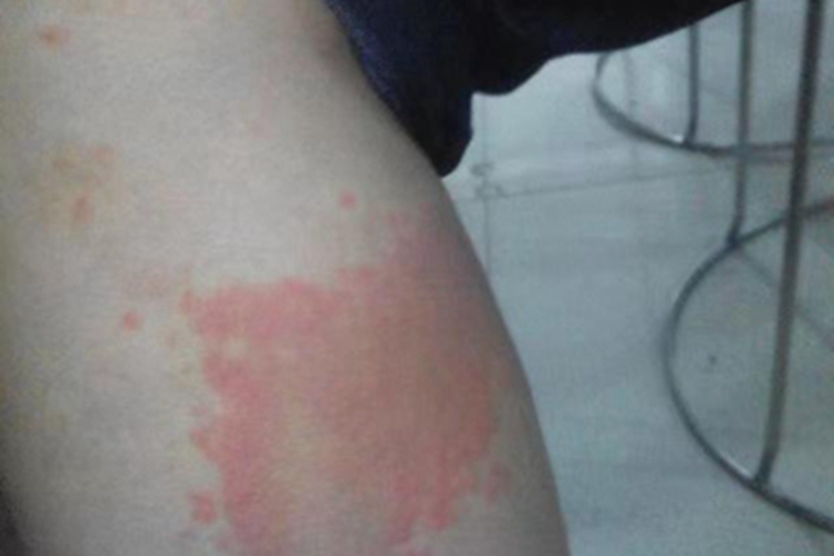 急性自发性荨麻疹腿红点图