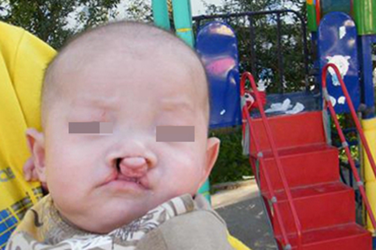 先天性风疹综合征肉球图