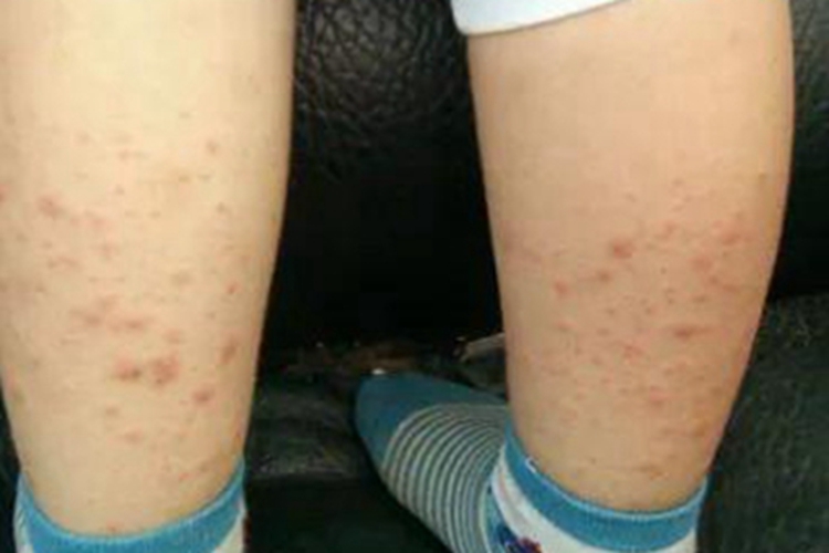 螨虫皮炎小腿大片疙瘩图