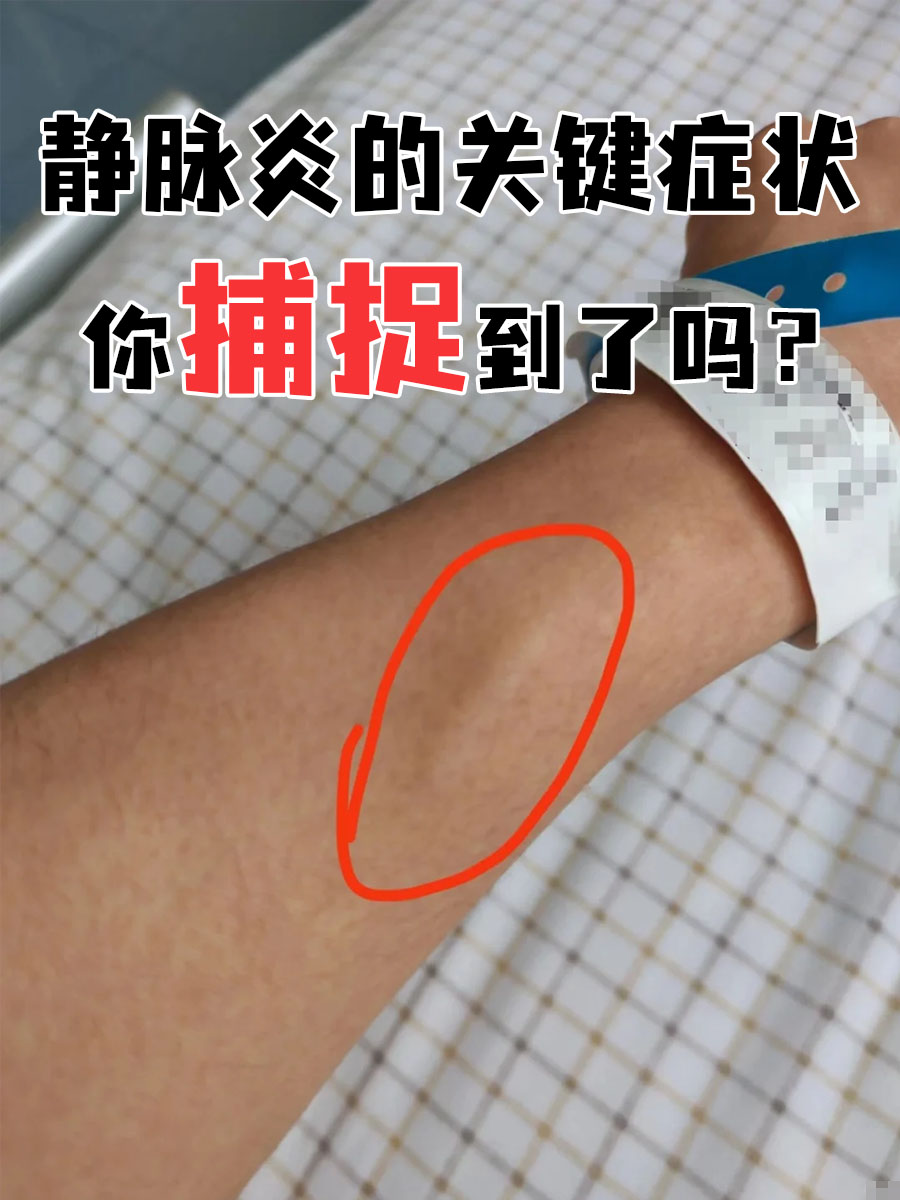 静脉炎的关键症状,你捕捉到了吗?