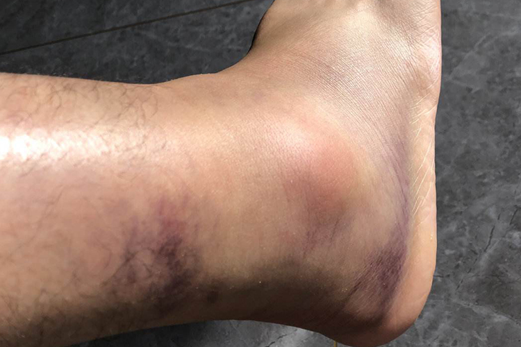 踝关节内翻扭伤图