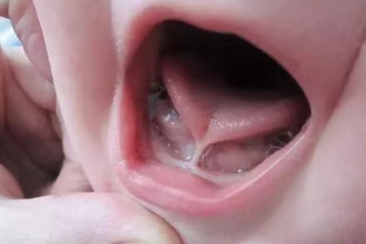 婴儿舌头下面的筋连着图 婴儿舌头下面的筋连着图