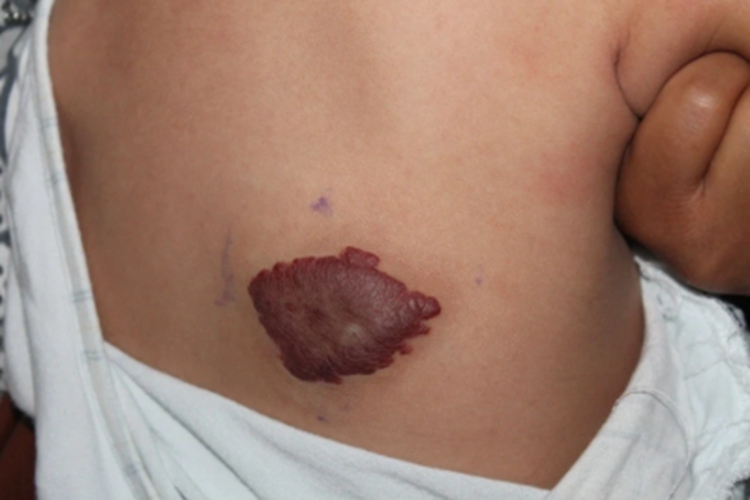 杆菌性血管瘤腰部红斑图