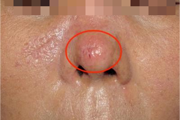 硬化性汗腺导管癌鼻尖症状图