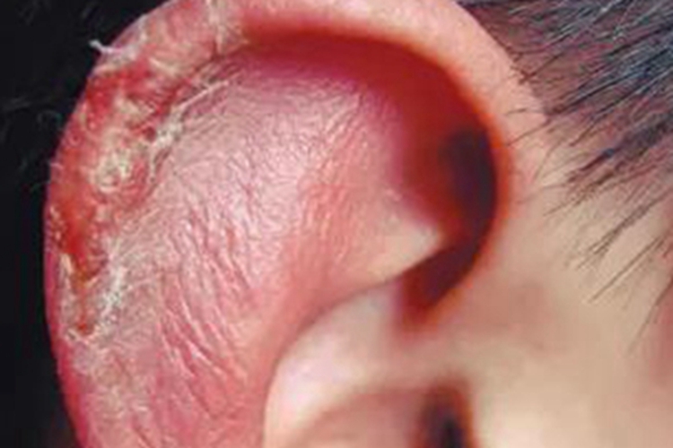 Ⅰ度冻伤耳廓发红脱皮图