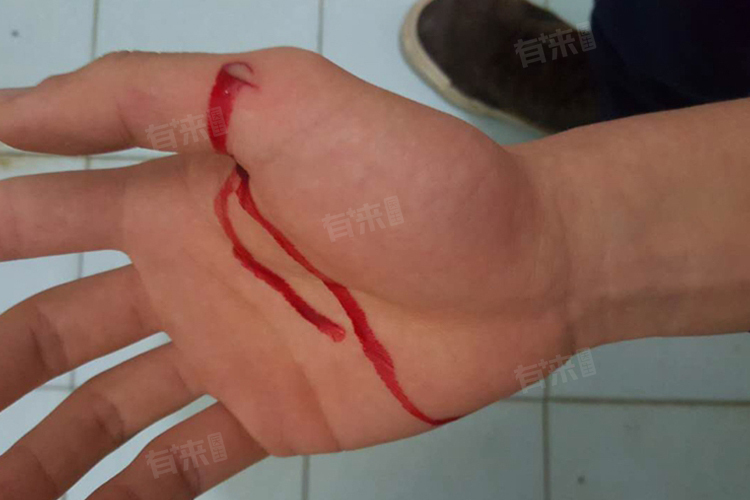 手被刀划了个口子怎么处理
