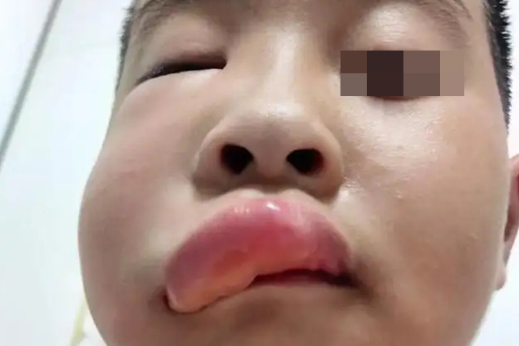 蜜蜂蜇伤右脸肿图 蜜蜂蜇伤右脸肿图