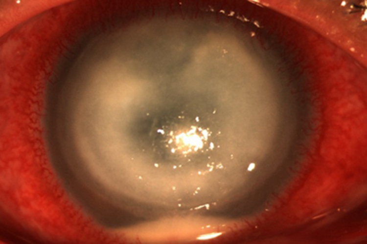 角膜挫伤症状图