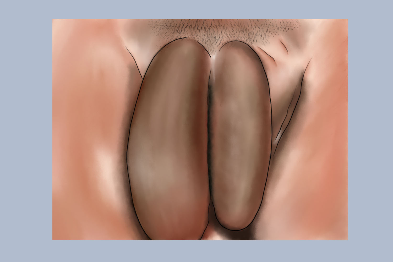 性病性淋巴肉芽肿晚期症状图 性病性淋巴肉芽肿晚期症状图