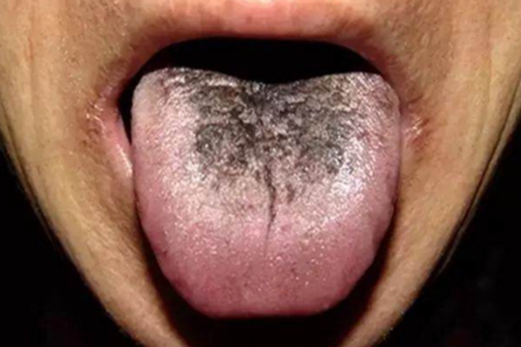 黑舌舌头上面有黑斑图