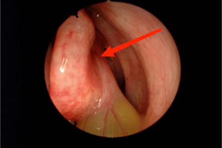 急性化脓性鼻窦炎鼻腔肿胀图