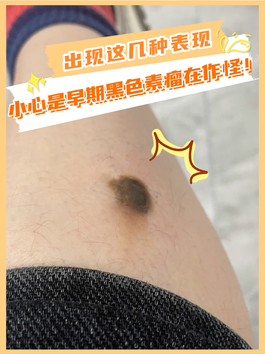 出现这几种表现，小心是早期黑色素瘤在作怪！