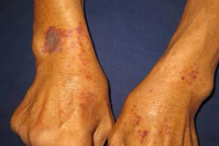 老年性紫癜手腕紫斑图