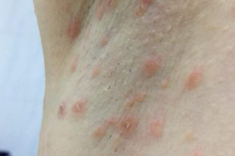 女生腋下毛囊炎图