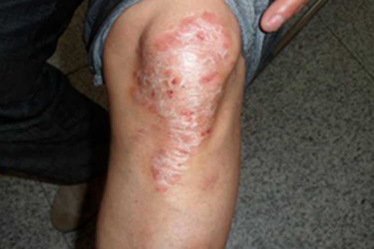 关节病型银屑病膝盖红斑图