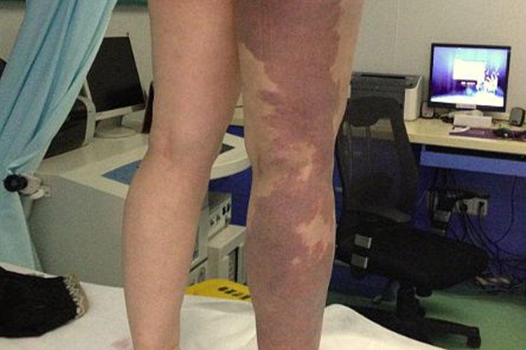 斑片状鲜红斑痣图