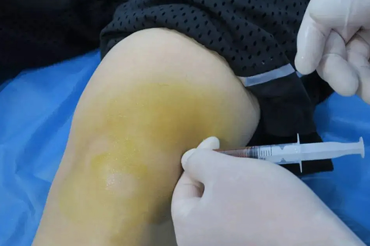 肌腱末端病膝盖上缘肿胀图