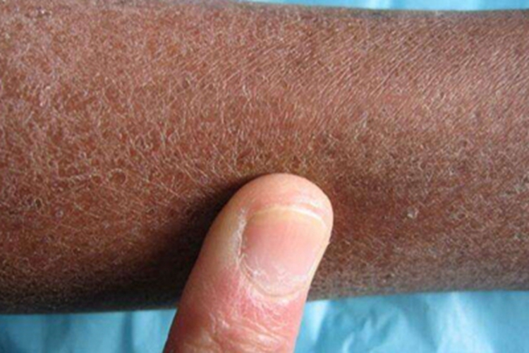 老年性皮肤萎缩胳膊脱屑图 老年性皮肤萎缩胳膊脱屑图