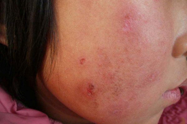 寒冷性多形红斑面部斑图