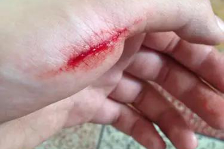 手被玻璃划伤出血图