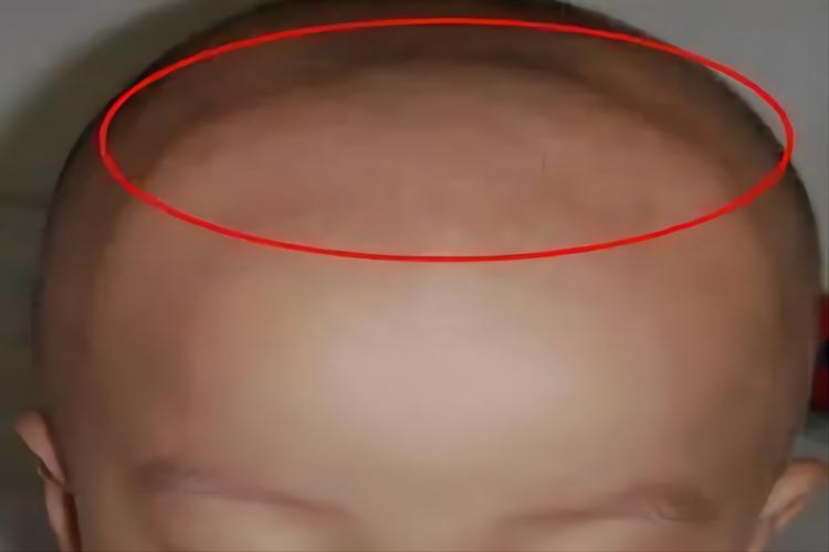 前囟门突出不正常图