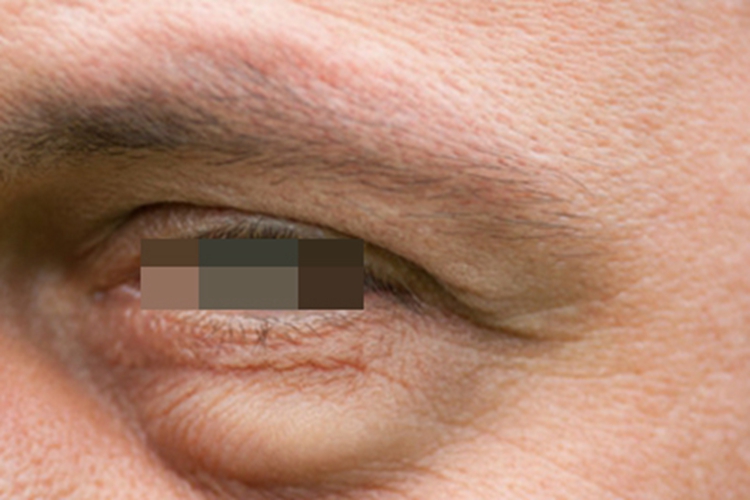 甲状腺功能减退症眼睑浮肿图