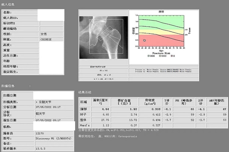 双能X线吸收法骨密度检测报告图