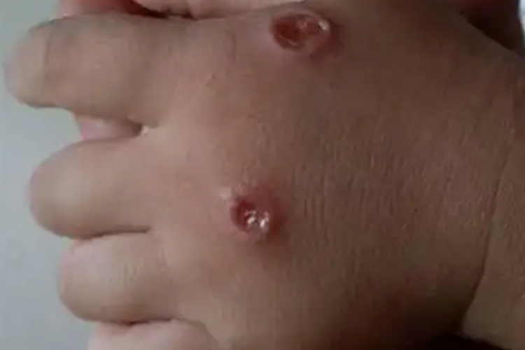 水痘破溃流脓图