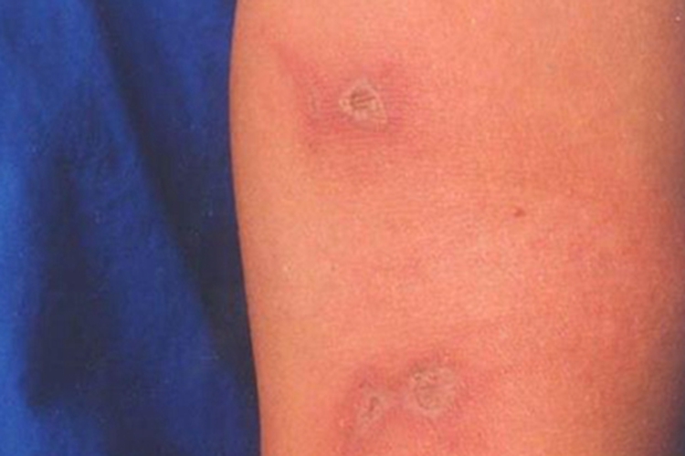 光线性痒疹胳膊上结痂图