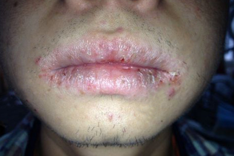 慢性光线性唇炎嘴唇结痂图 慢性光线性唇炎嘴唇结痂图