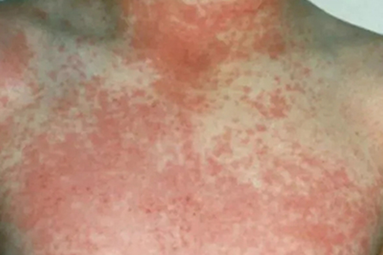 梅毒胸口红斑图 梅毒胸口红斑图