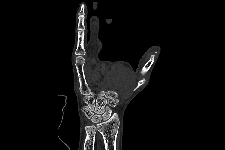 手部CT小拇指图