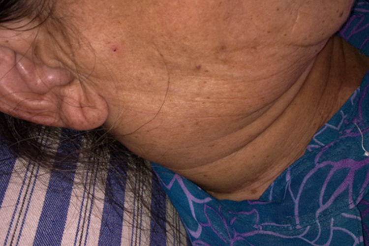 女人艾滋病淋巴结肿大图