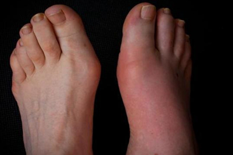 痛风脚上明显红肿有对比图