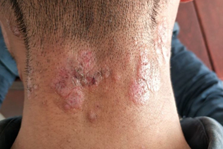 慢性光化性皮炎后颈症状图