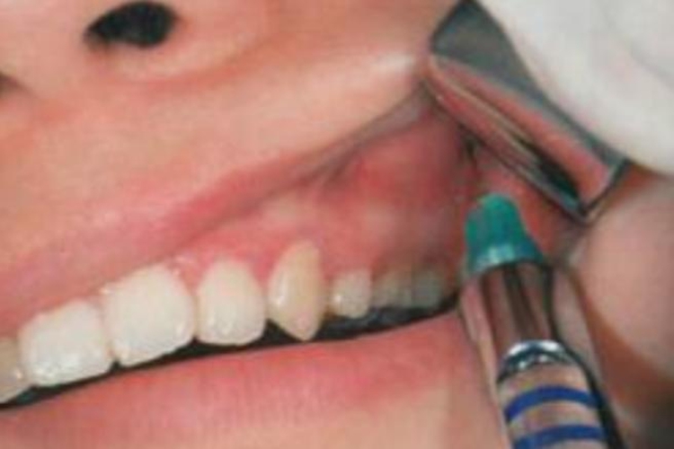 上牙槽后神经局麻图