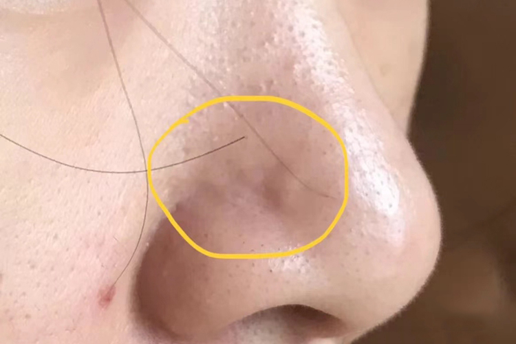 脂肪瘤图 脂肪瘤图