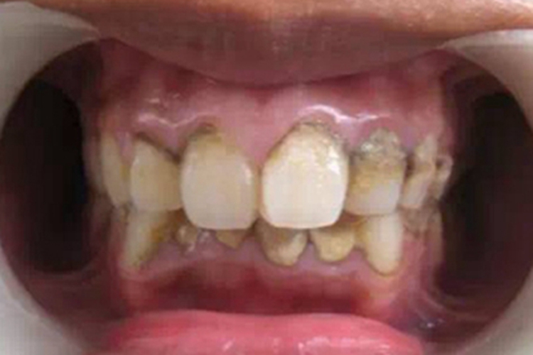 牙龈萎缩牙龈发白牙根变黑图 牙龈萎缩牙龈发白牙根变黑图
