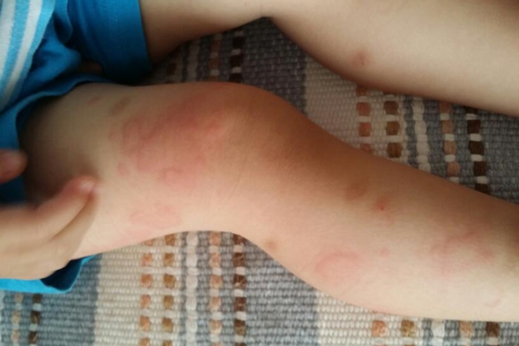 小孩慢性自发性荨麻疹图 小孩慢性自发性荨麻疹图