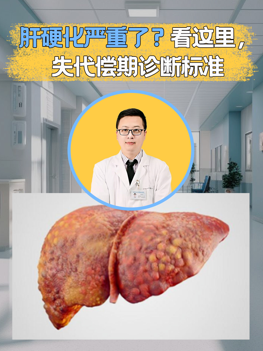 肝硬化严重了?看这里,失代偿期诊断标准