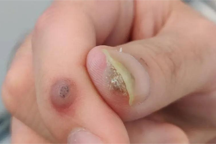 甲下疣指甲凸起小包图