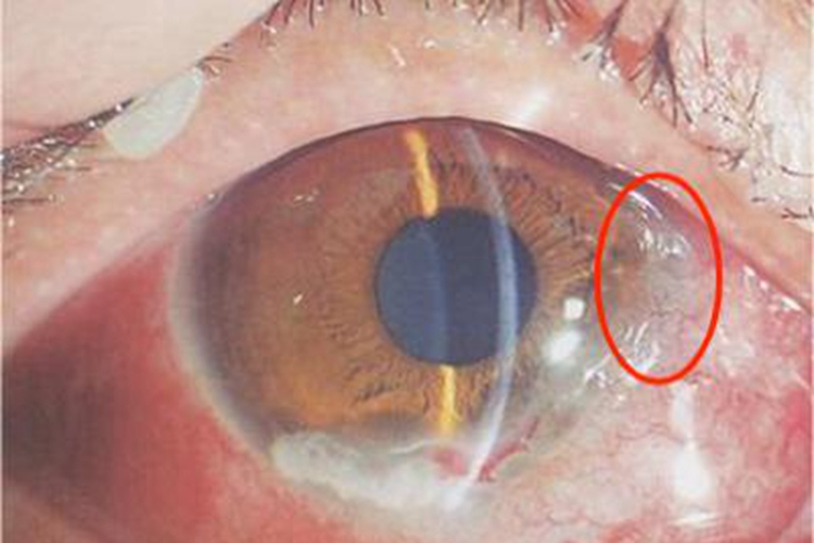 边缘性角膜变性水肿图 边缘性角膜变性水肿图