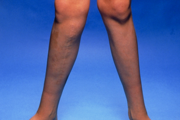 宝宝缺钙X型腿图