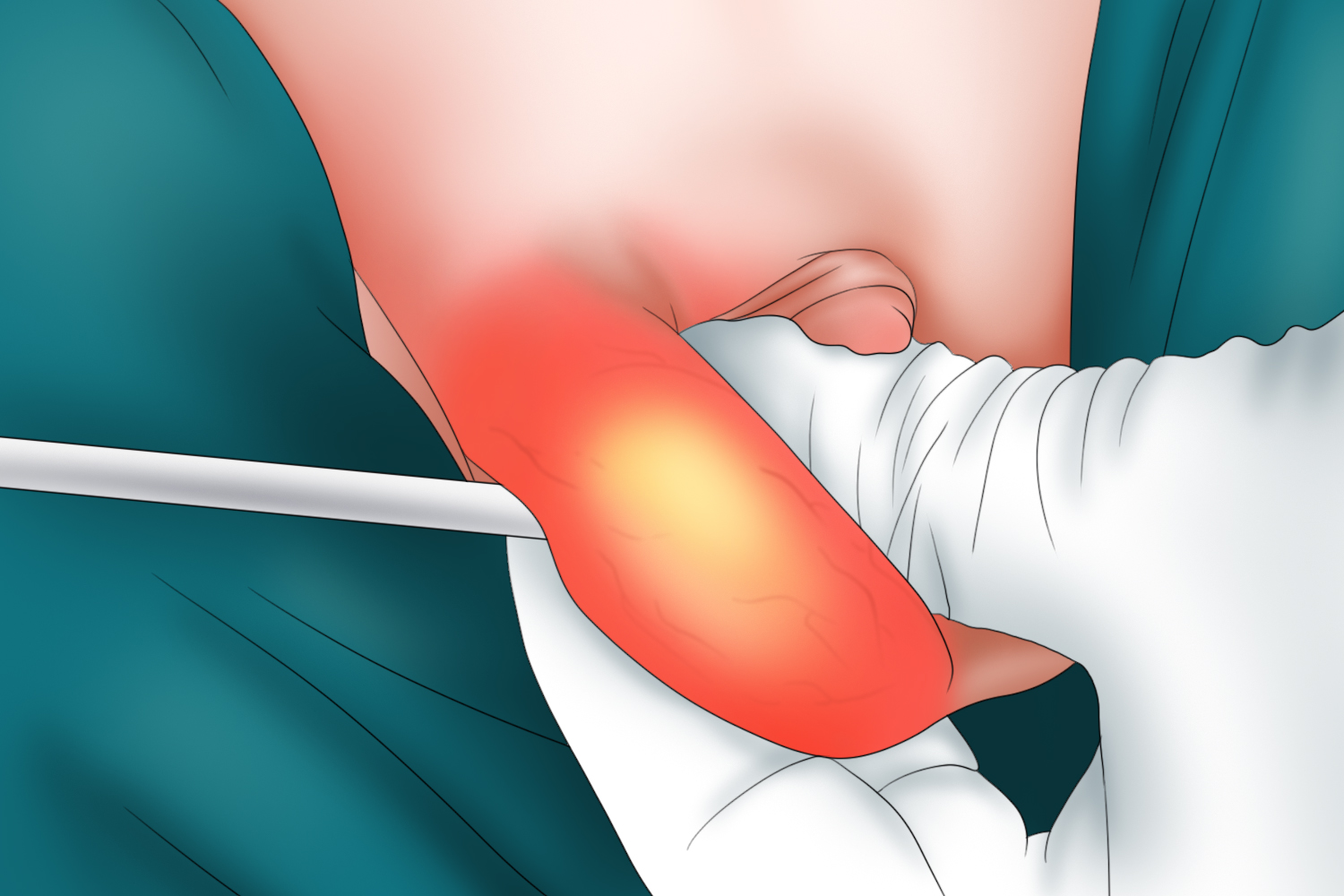 鞘膜积液透光试验图 鞘膜积液透光试验图