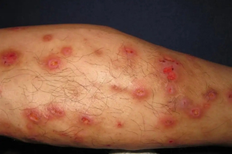 硬结性红斑症状图 硬结性红斑症状图