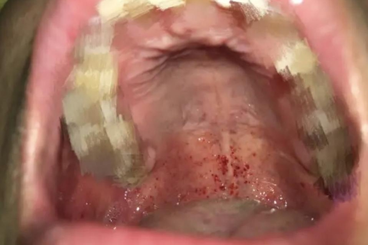 药物过敏性口炎上腭红点图